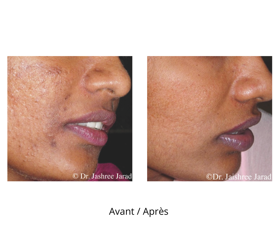 Dermaroller microneedling professionnel 18 rangées d’aiguilles avec profondeur de 2.5 mm