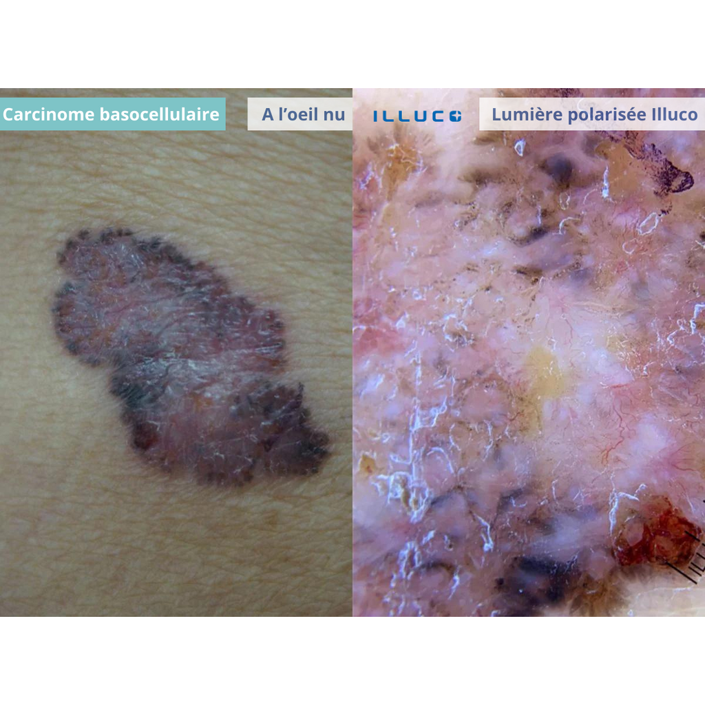 Dermatoscope rechargeable ILLUCO IDS-1100