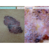 Dermatoscope rechargeable ILLUCO IDS-1100