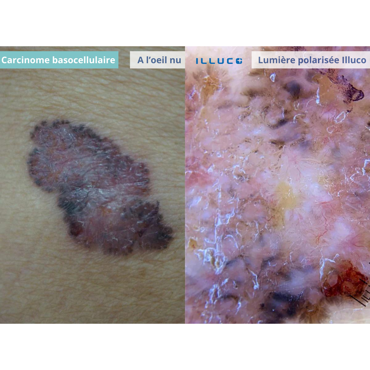 Dermatoscope rechargeable ILLUCO IDS-1100