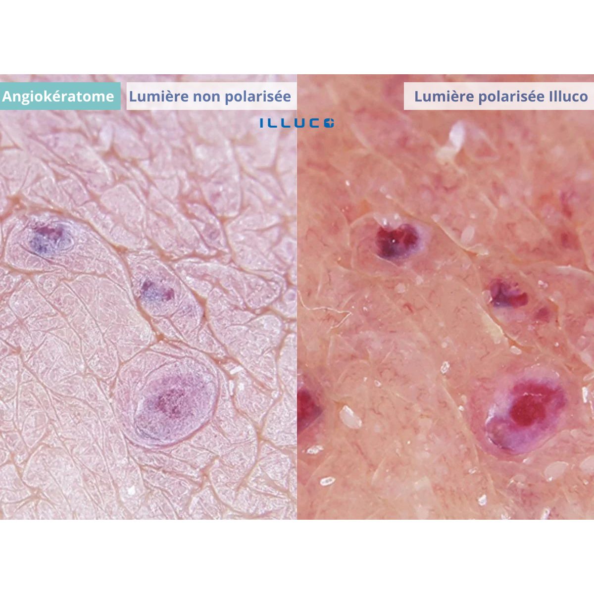 Dermatoscope rechargeable ILLUCO IDS-1100