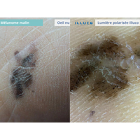 Dermatoscope rechargeable ILLUCO IDS-1100