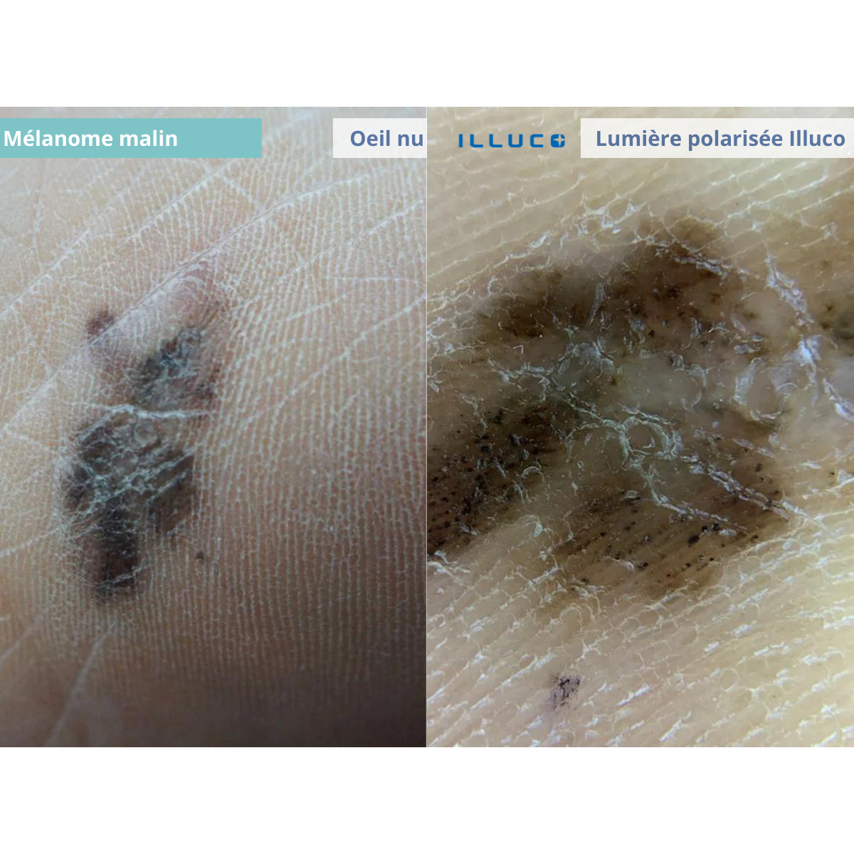 Dermatoscope rechargeable ILLUCO IDS-1100