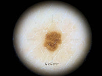 Embout de contact petites surfaces pour DL4 Dermlite